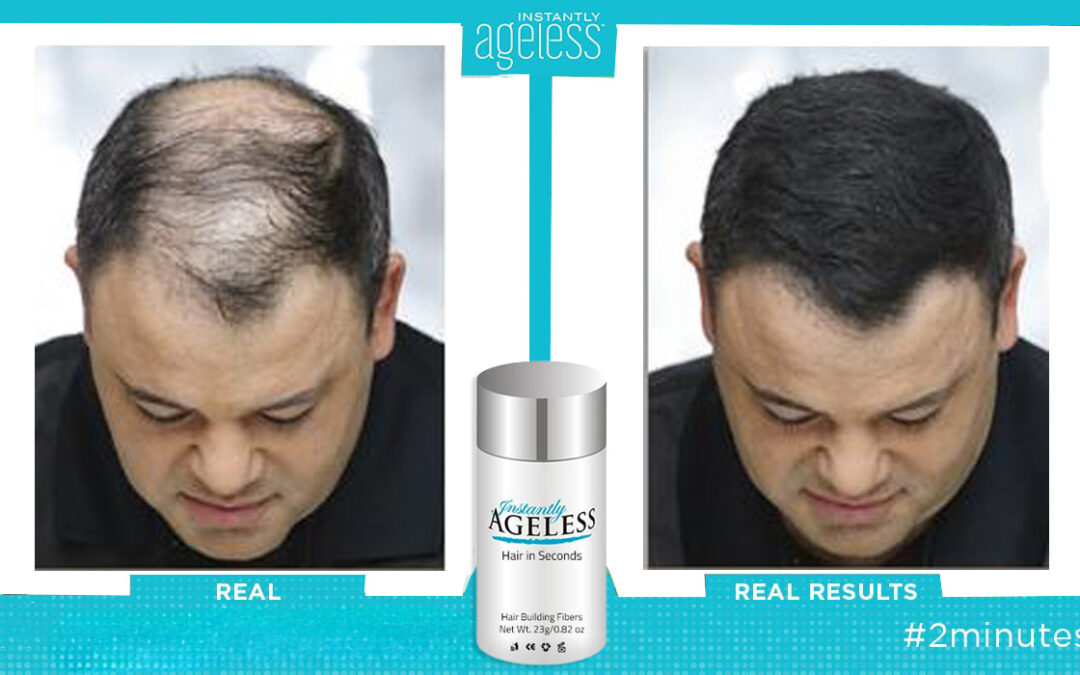 Male Pattern Baldness Solutions
