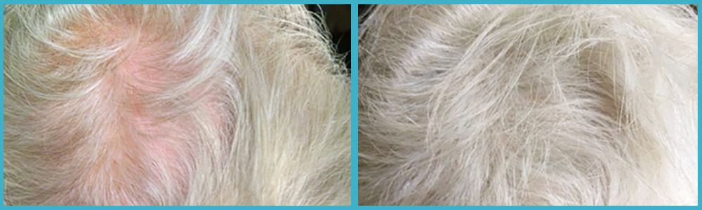 Thinning Hair Remedies